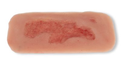 Wound moulage arterial leg ulcer, small, epithelization phase