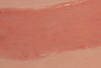 Wound moulage arterial leg ulcer, large, epithelization phase