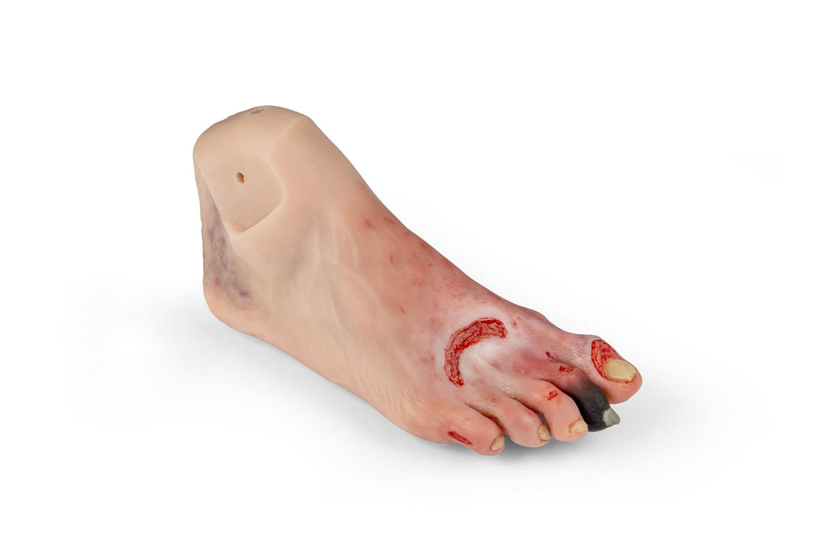 Wound foot with diabetic foot syndrome for Nursing Anne | Erler-Zimmer PW006NA
