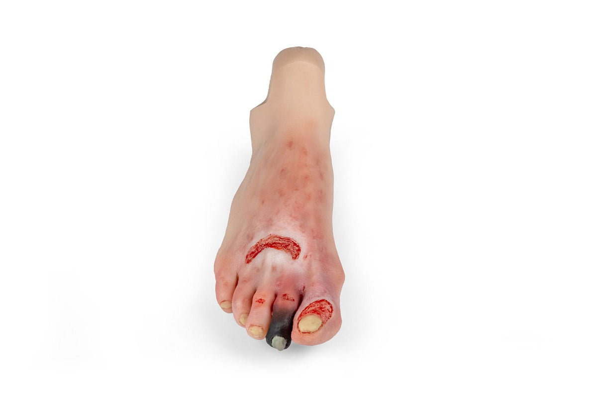 Wound foot with diabetic foot syndrome for Nursing Anne | Erler-Zimmer PW006NA
