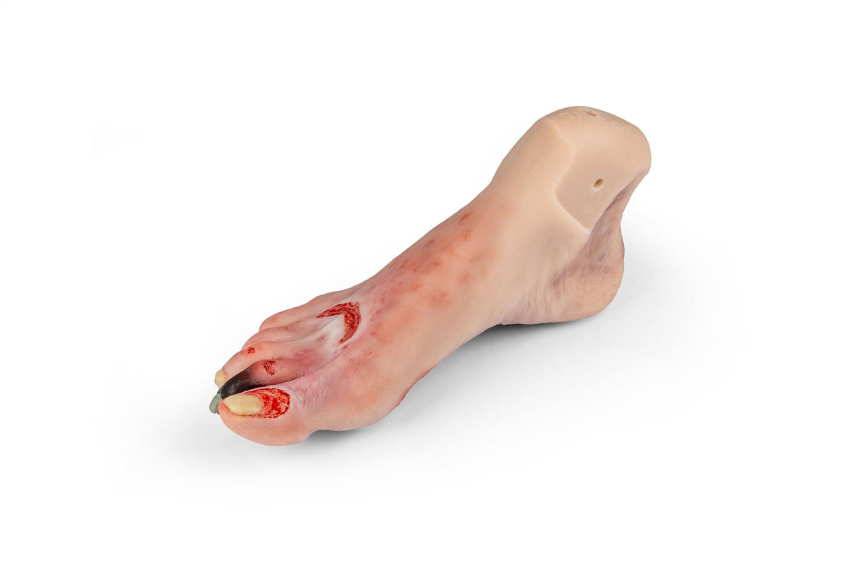 Wound foot with diabetic foot syndrome for Nursing Anne | Erler-Zimmer PW006NA