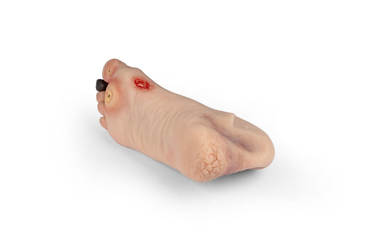 Wound foot with diabetic foot syndrome for Nursing Anne | Erler-Zimmer PW006NA