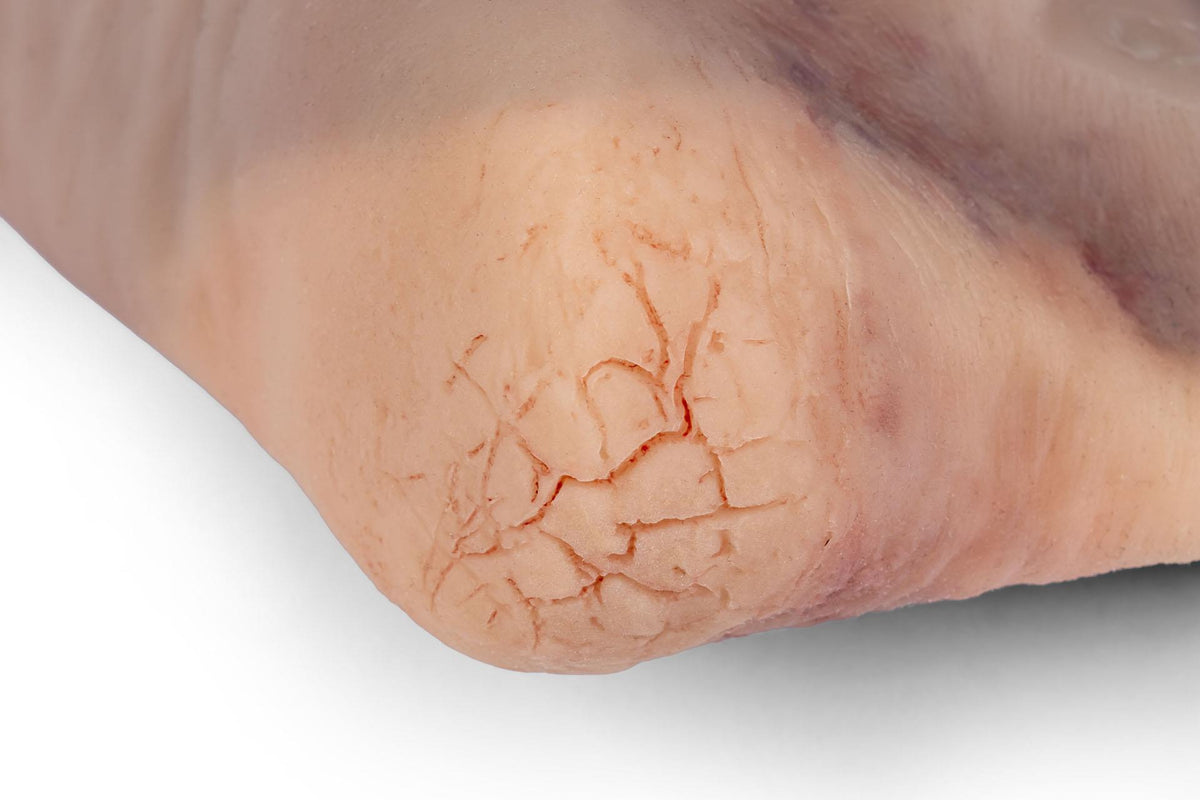 Wound foot with diabetic foot syndrome for Nursing Anne | Erler-Zimmer PW006NA