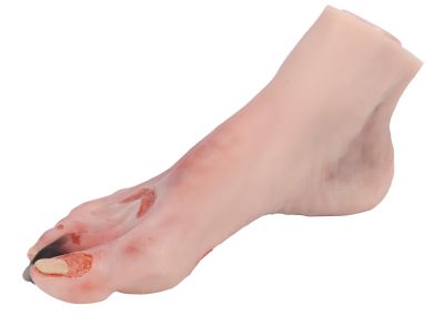 Wound foot with diabetic foot syndrome - Erler-Zimmer PW006, view 3