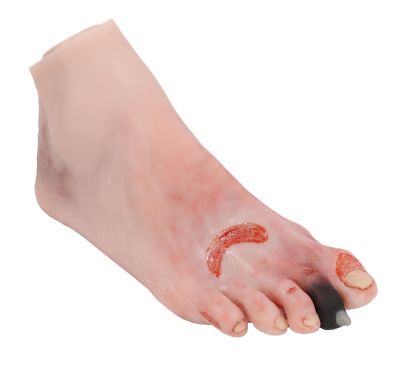 Wound foot with diabetic foot syndrome - Erler-Zimmer PW006