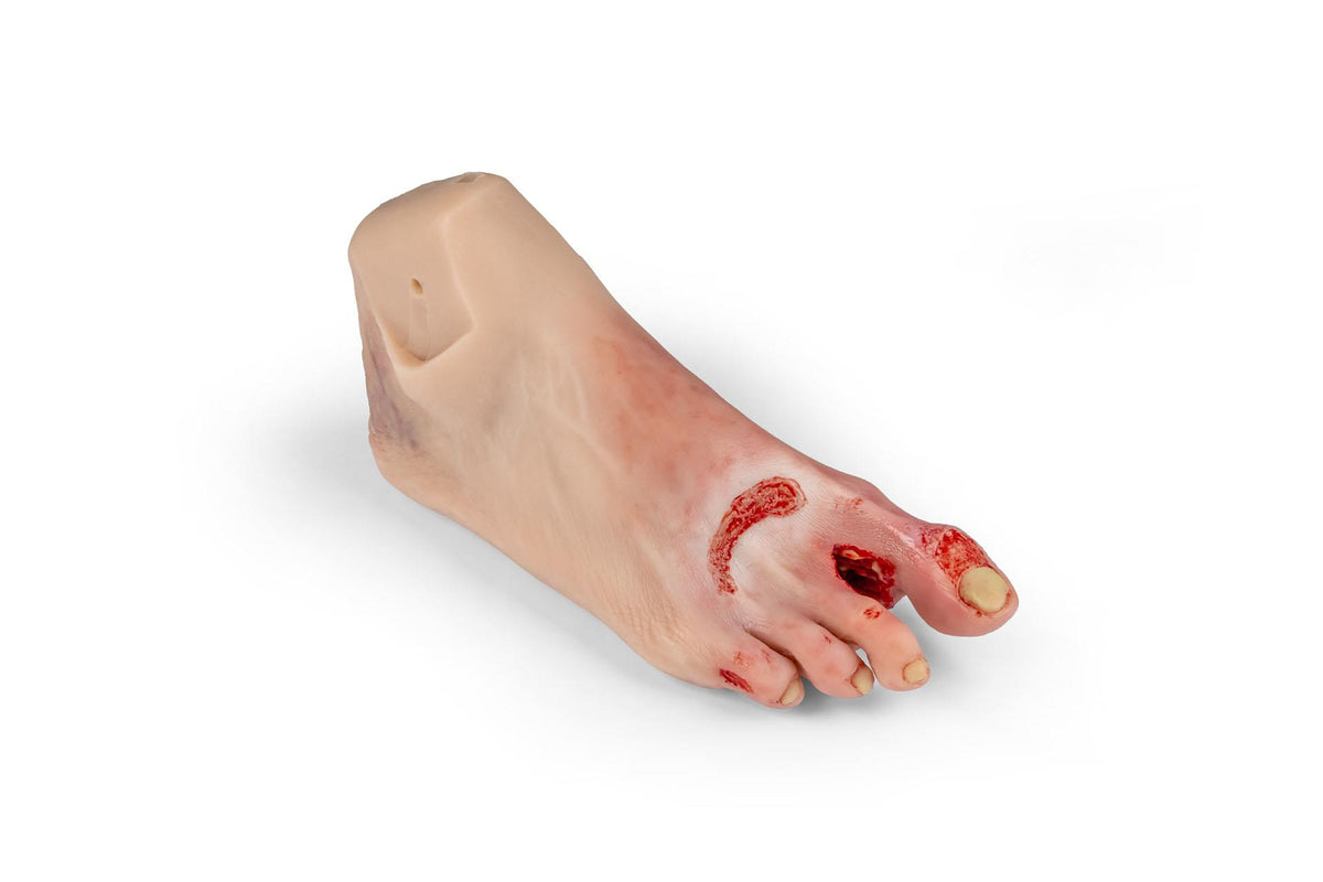 Wound foot with diabetic foot syndrome, severe stage, Nurisng Anne version | Erler-Zimmer PW007NA