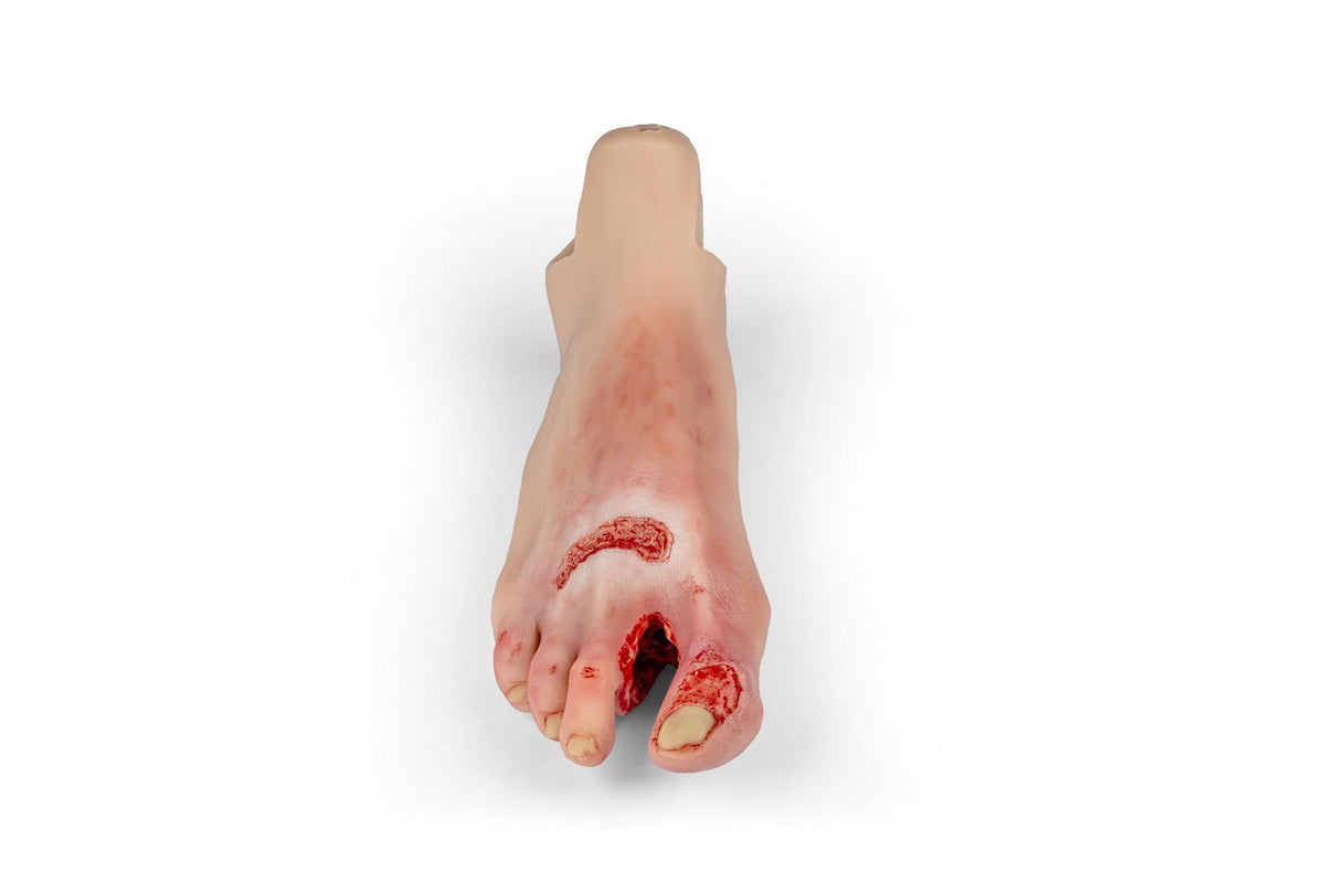 Wound foot with diabetic foot syndrome, severe stage, Nurisng Anne version | Erler-Zimmer PW007NA