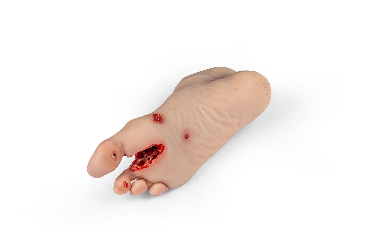 Wound foot with diabetic foot syndrome, severe stage, Nurisng Anne version | Erler-Zimmer PW007NA