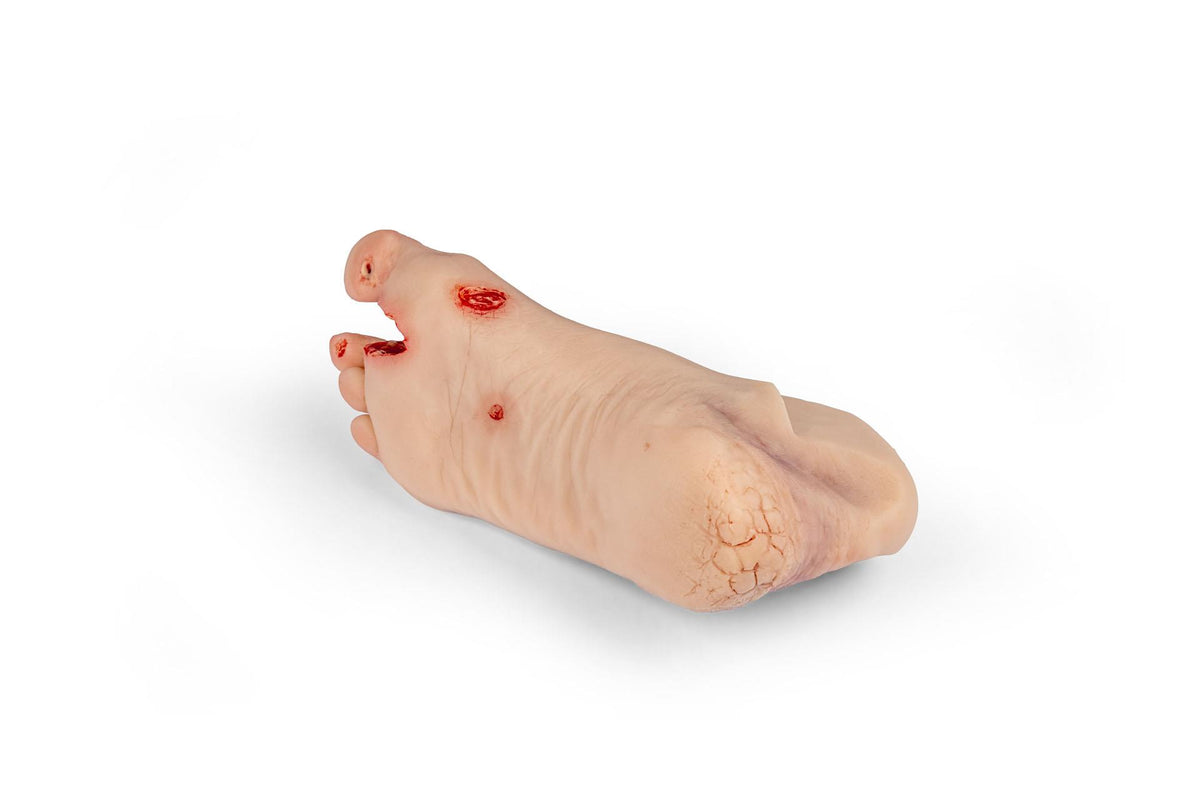 Wound foot with diabetic foot syndrome, severe stage, Nurisng Anne version | Erler-Zimmer PW007NA