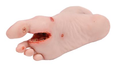 Wound foot with diabetic foot syndrome, severe stage, manikin version - Erler-Zimmer PW007P, view 5