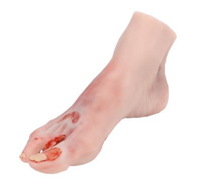 Wound foot with diabetic foot syndrome, severe stage - Erler-Zimmer PW007, view 2