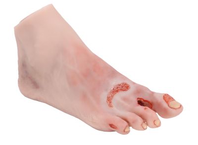 Wound foot with diabetic foot syndrome, severe stage - Erler-Zimmer PW007