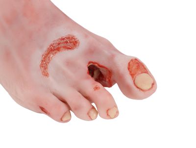 Wound foot with diabetic foot syndrome, severe stage - Erler-Zimmer PW007, view 5