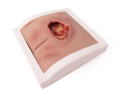Wound moulage sacral decubitus, cleaned including stand - Erler-Zimmer PW008BTM, view 2