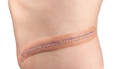 Surgical wound, with suture, 22cm - Erler-Zimmer PW009B, view 2
