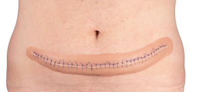 Surgical wound, with suture, 22cm - Erler-Zimmer PW009B, view 3