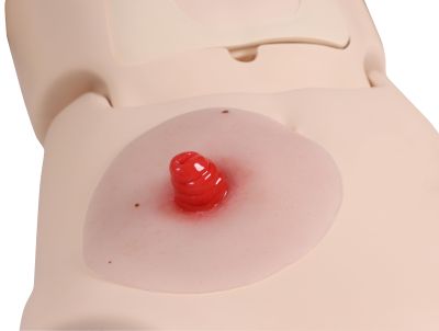 Ileostomy wound moulage, self-adhesive - Erler-Zimmer PW020P, view 3
