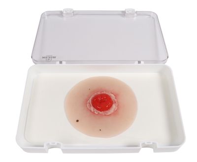 Wound moulage Colostomy inflamed, self-adhesive - Erler-Zimmer PW022P