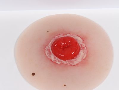 Wound moulage Colostomy inflamed, self-adhesive - Erler-Zimmer PW022P, view 2