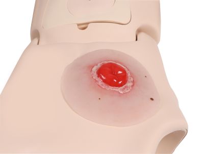 Wound moulage Colostomy inflamed, self-adhesive - Erler-Zimmer PW022P, view 3