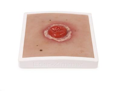 Wound Moulage Colostomy with inflammation, incl. stand - Erler-Zimmer PW022, view 2