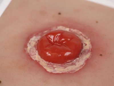 Wound Moulage Colostomy with inflammation, incl. stand - Erler-Zimmer PW022, view 5