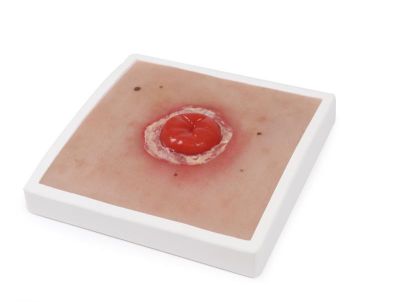 Wound Moulage Colostomy with inflammation, incl. stand - Erler-Zimmer PW022, view 3