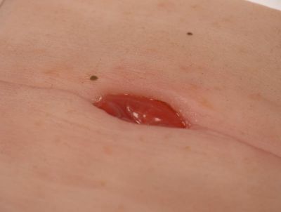 Wound Moulage Colostomy in abdominal crease, incl. stand - Erler-Zimmer PW023, view 3