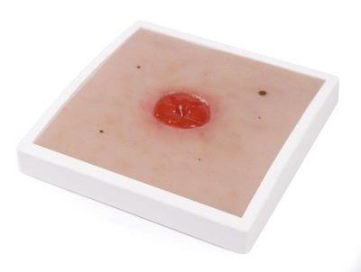 Wound Moulage Colostomy under skin level, incl. stand - Erler-Zimmer PW024