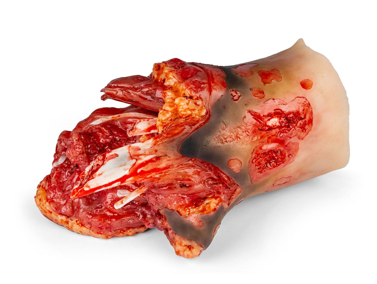 Amputation stump leg right, Combat Carl | Erler-Zimmer T3C9