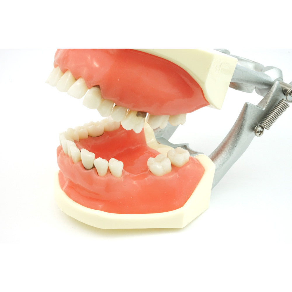 TR56C Hygiene Model with #19 edentulous and #14 super errupted