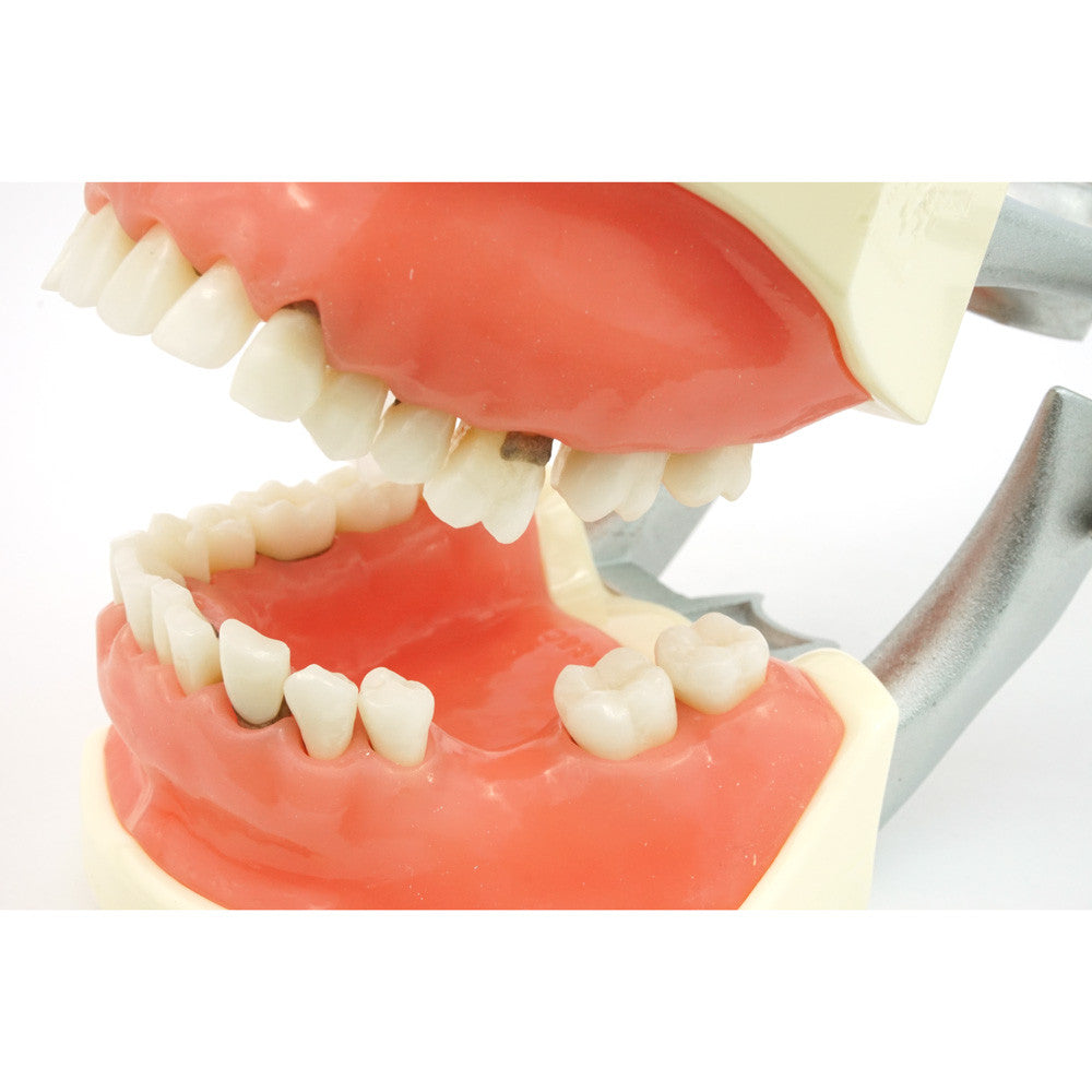 TR56C Hygiene Model with #19 edentulous and #14 super errupted