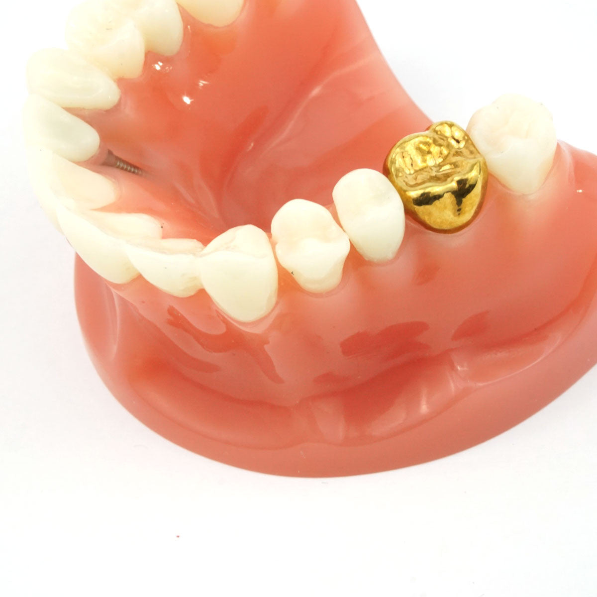 Cosmetic Crown & Bridge Model