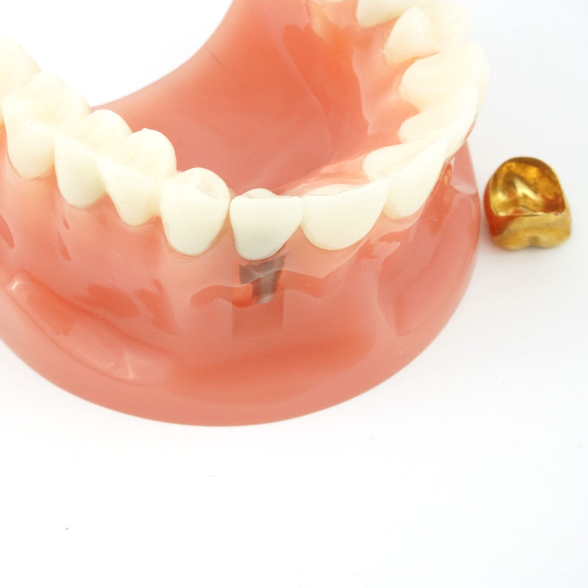 Cosmetic Crown & Bridge Model