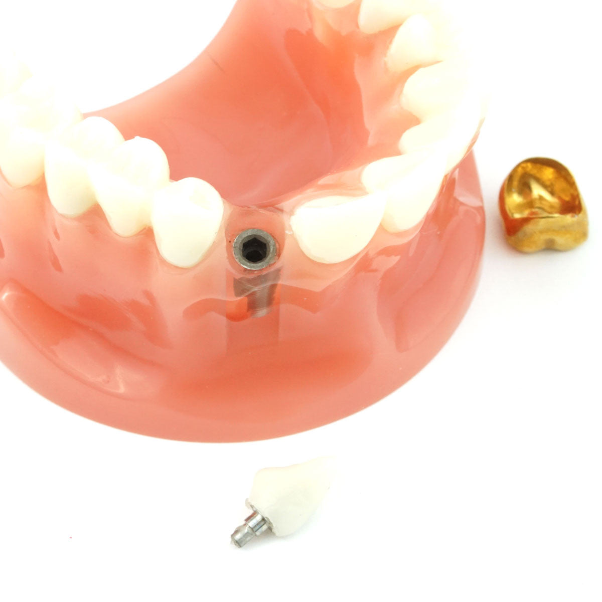 Cosmetic Crown & Bridge Model