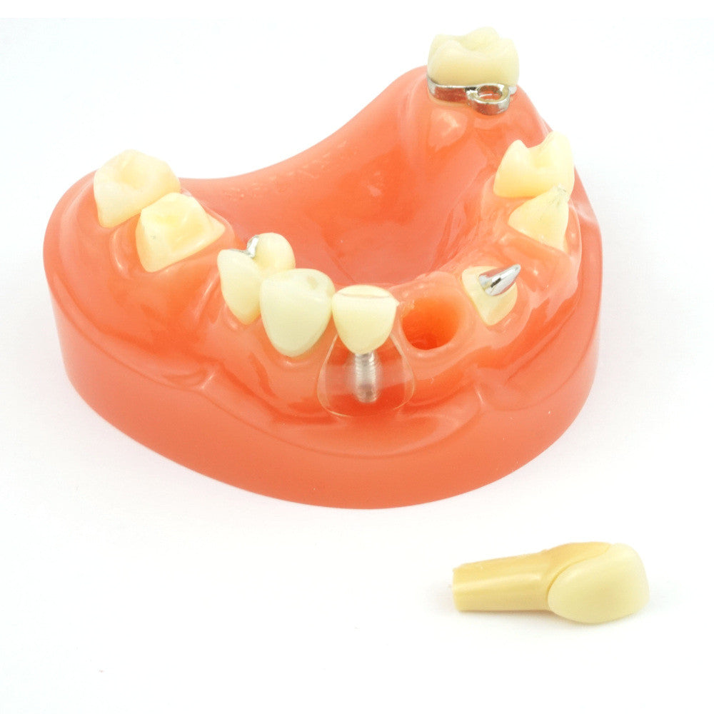 Crown & Bridge Model w/ Partial