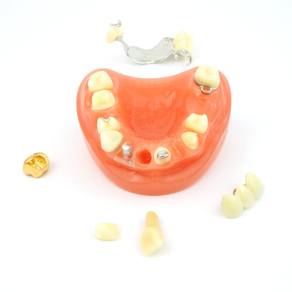 Crown & Bridge Model w/ Partial