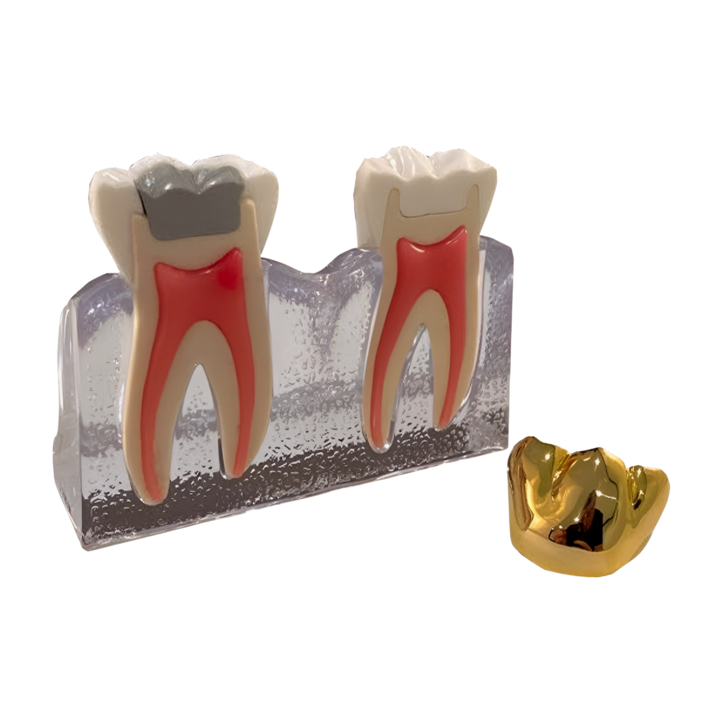 P13-TRM.447 cracked tooth model, post-treatment crown restoration