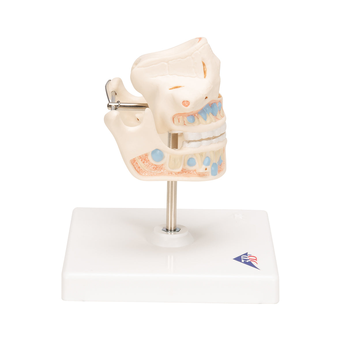 Milk Denture Model with Remaining Teeth