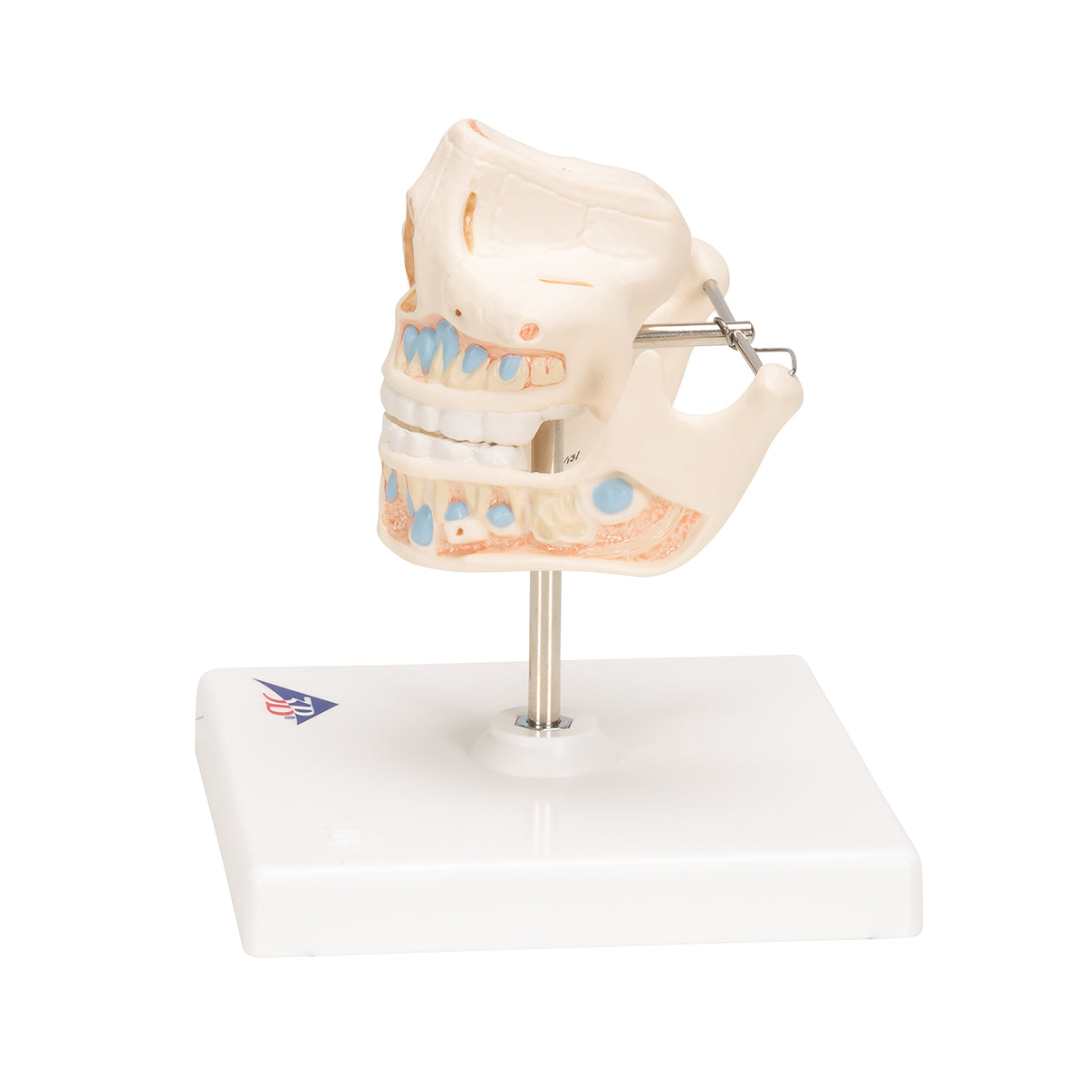 Milk Denture Model with Remaining Teeth