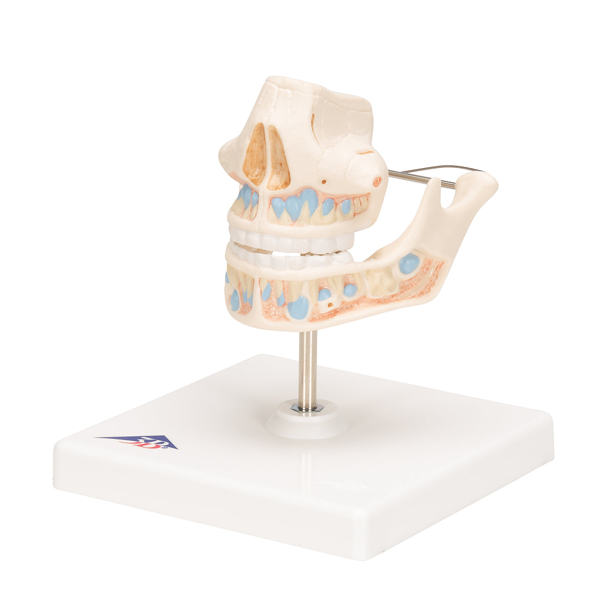 Milk Denture Model with Remaining Teeth