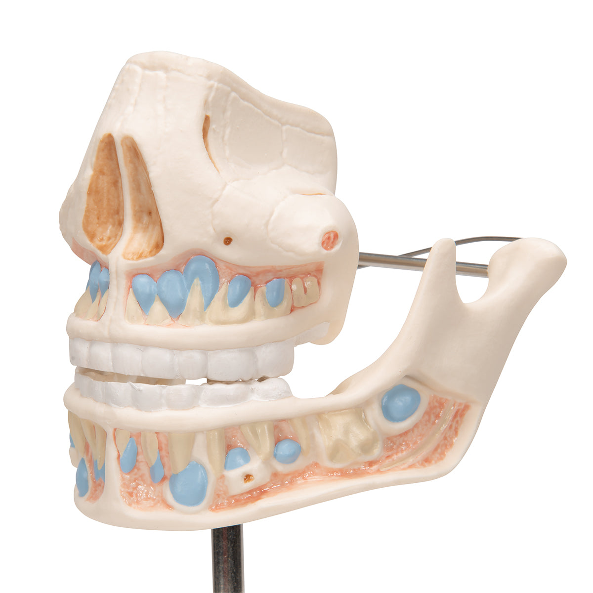 Milk Denture Model with Remaining Teeth