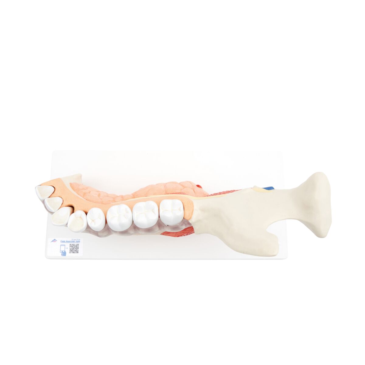 Comprehensive Lower Jaw Model (Left Half) with Diseased Teeth, Nerves, Vessels & Glands, 19 part