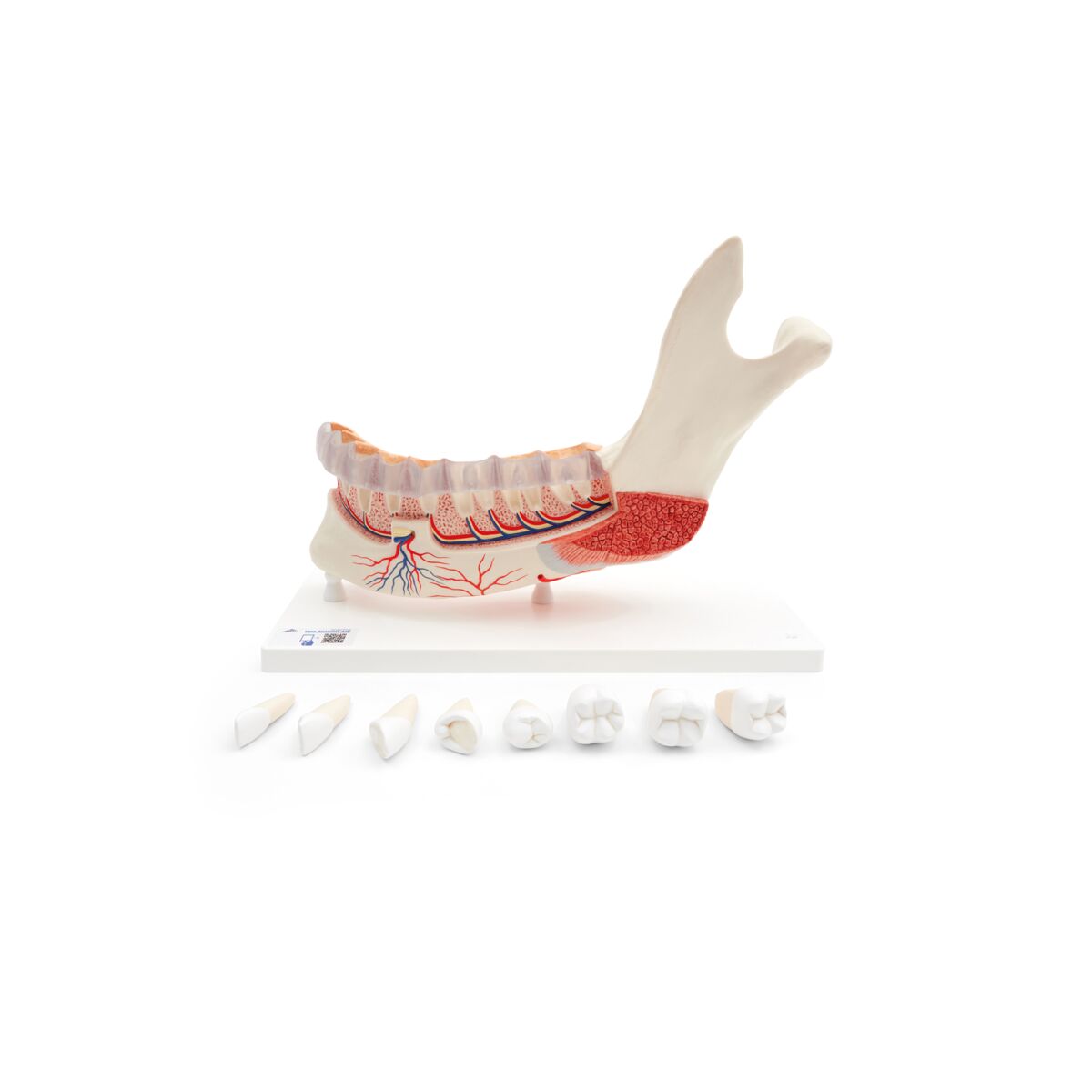 Comprehensive Lower Jaw Model (Left Half) with Diseased Teeth, Nerves, Vessels & Glands, 19 part