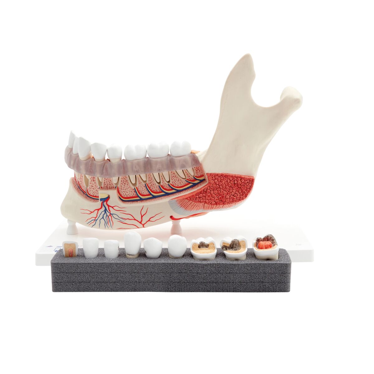 Comprehensive Lower Jaw Model (Left Half) with Diseased Teeth, Nerves, Vessels & Glands, 19 part