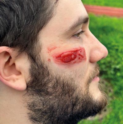 Wound Moulages - Set Standard