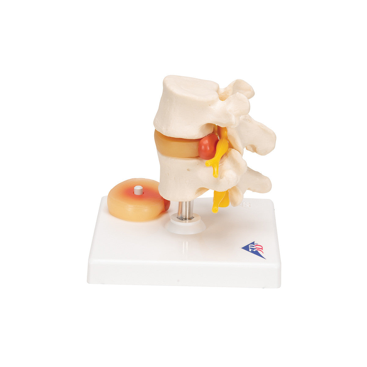 a76_02_1200_1200_human-lumbar-spinal-column-with-prolapsed-intervertebral-disc-3b-smart-anatomy__76270.1589753296.1280.1280.jpg