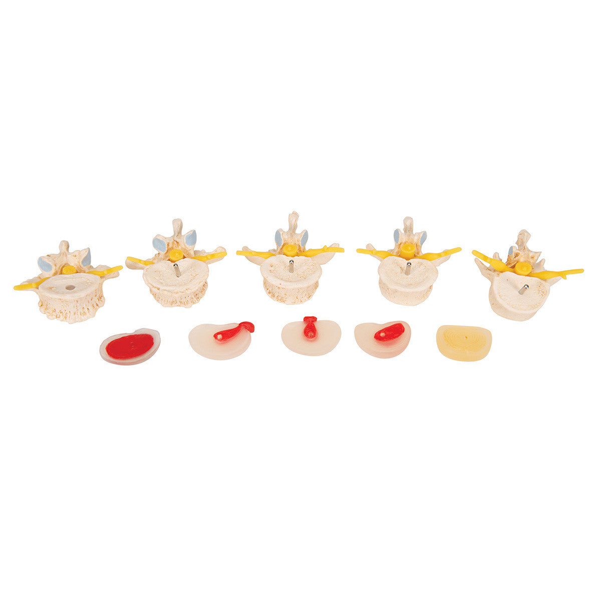 a795_06_1200_1200_stages-of-disc-prolapse-and-vertebral-degeneration-3b-smart-anatomy__03682.1589753281.1280.1280.jpg
