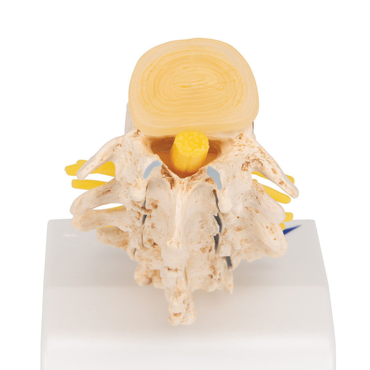 a795_07_1200_1200_stages-of-disc-prolapse-and-vertebral-degeneration-3b-smart-anatomy__85736.1589753280.1280.1280.jpg