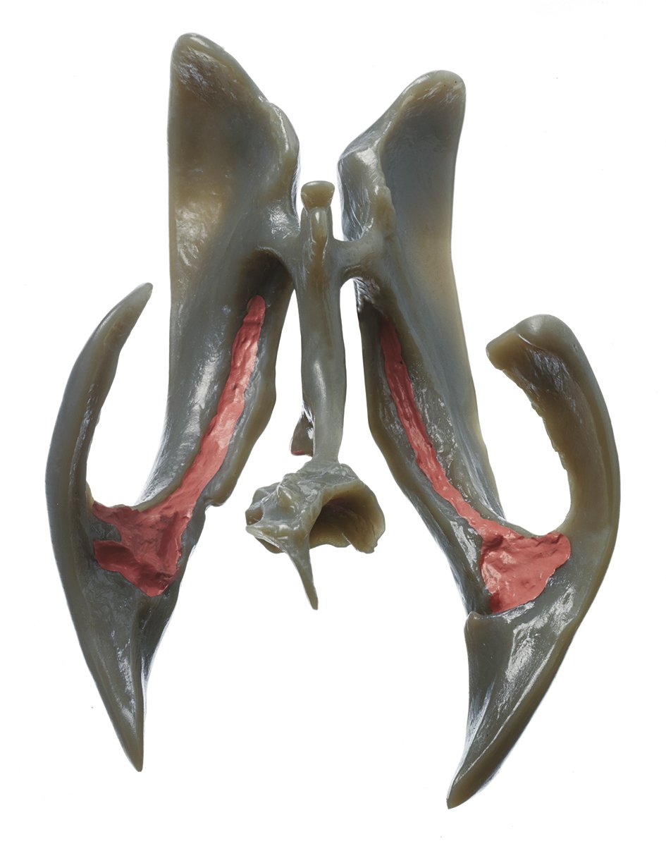 Ventricular Cavities of the Brain